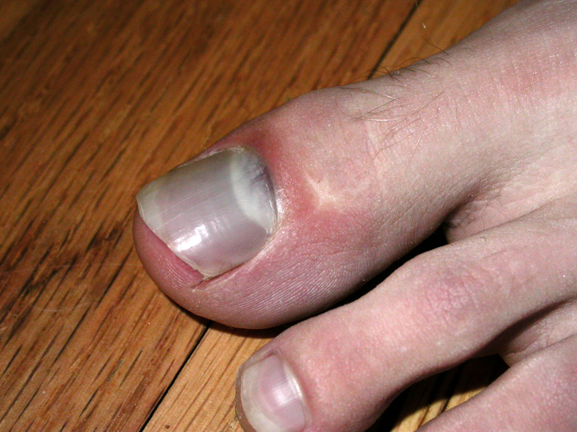 77 - Chaz's Toe